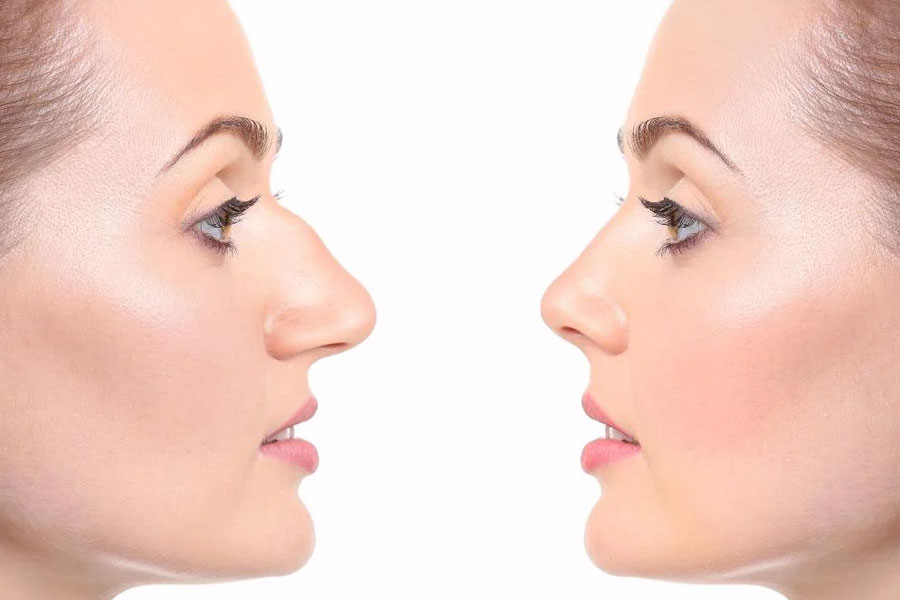 Best Affordable Rhinoplasty (Nose Job) Tour in Iran