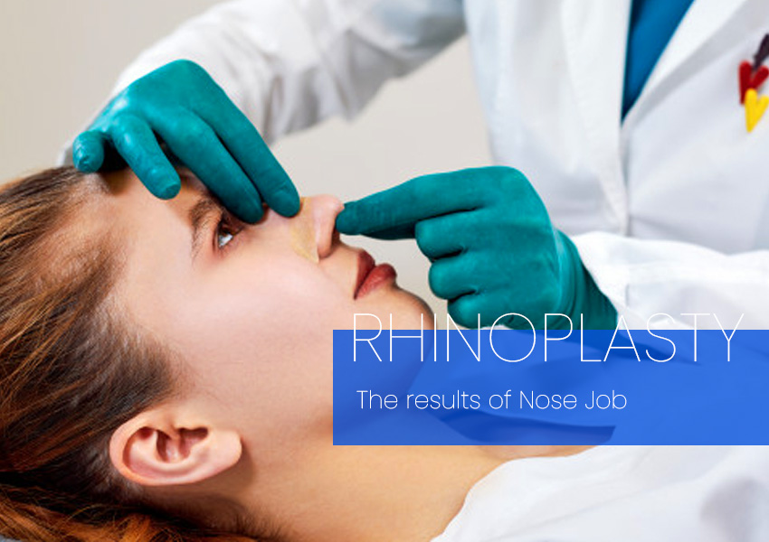rhinoplasty surgery nose job result expectation