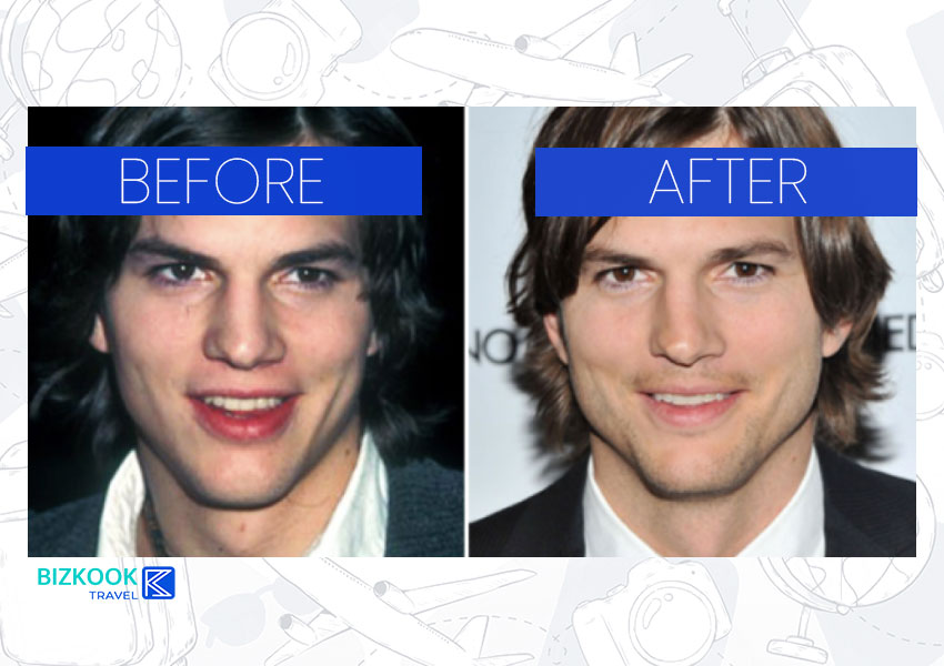Male Celebrity Nose Jobs . Ashton Kutcher Before After Rhinoplasty