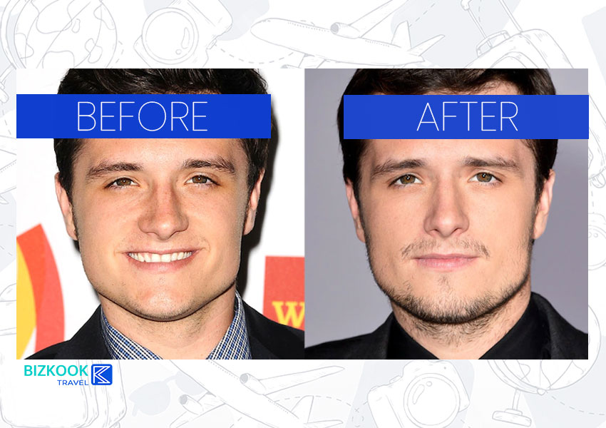 Male Celebrity Nose Jobs . Josh Hutcherson Before After Rhinoplasty