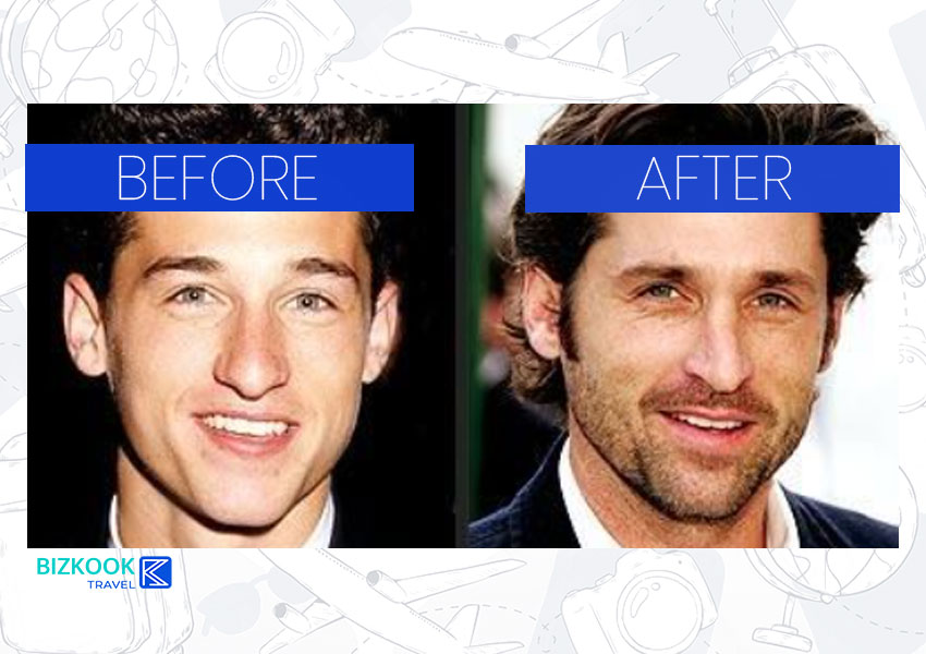 Male Celebrity Nose Jobs . Patrick Dempsey Before After Rhinoplasty
