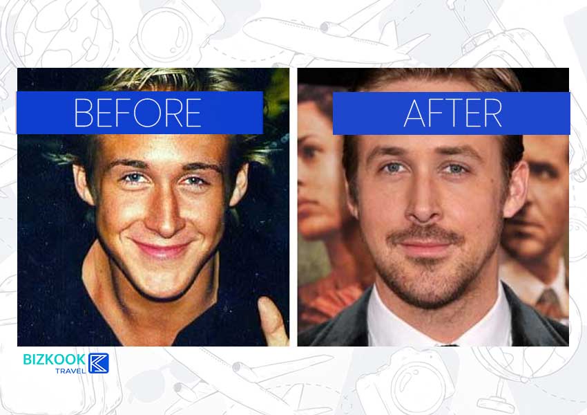 Male Celebrity Nose Jobs . Ryan Gosling Before After Rhinoplasty