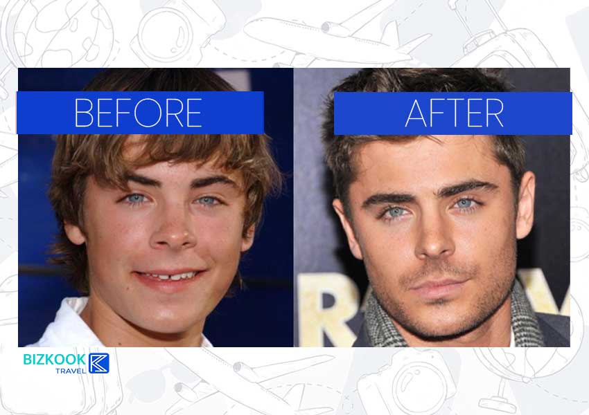 Male Celebrity Nose Jobs . Zac Efron Before After Rhinoplasty