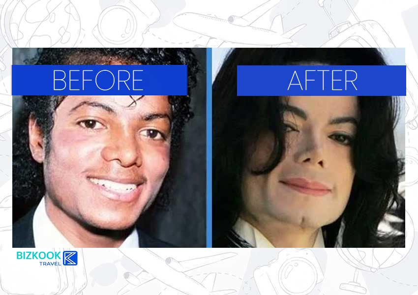 Male Celebrity Nose Jobs . Michael Jackson Before After Rhinoplasty