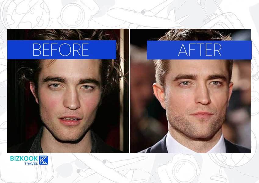 Male Celebrity Nose Jobs . Robert Pattinson Before After Rhinoplasty