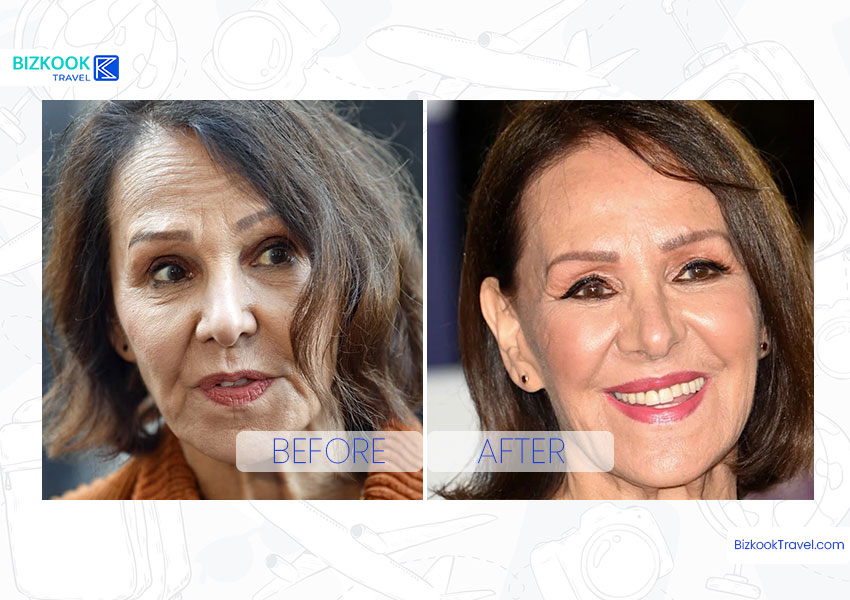 Arlene Phillips Plastic Surgery Before & After