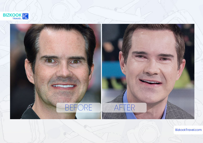 Jimmy Carr Plastic Surgery Before and After