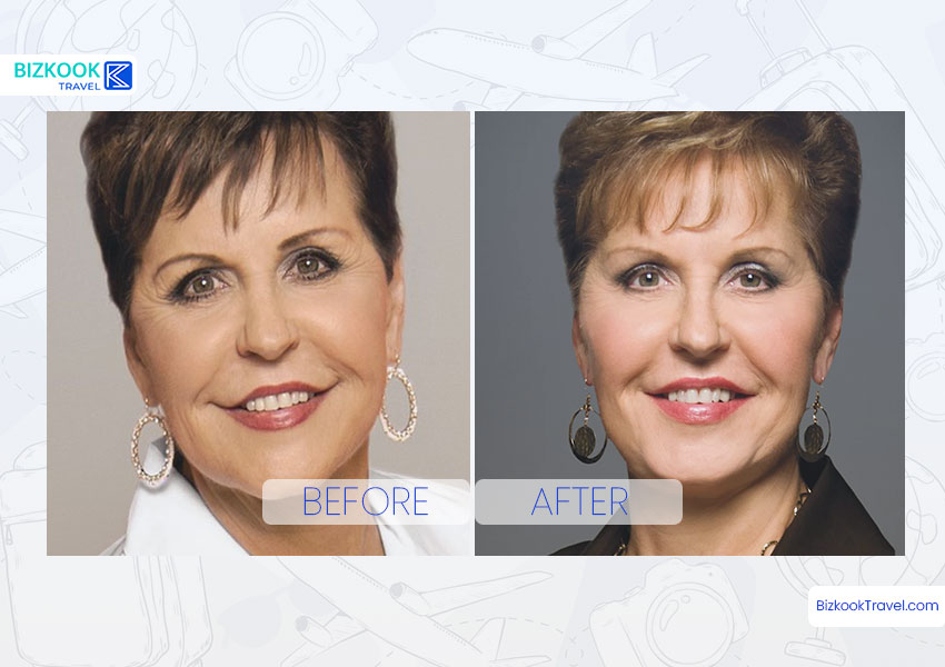 Joyce Meyer Plastic Surgery Before & After
