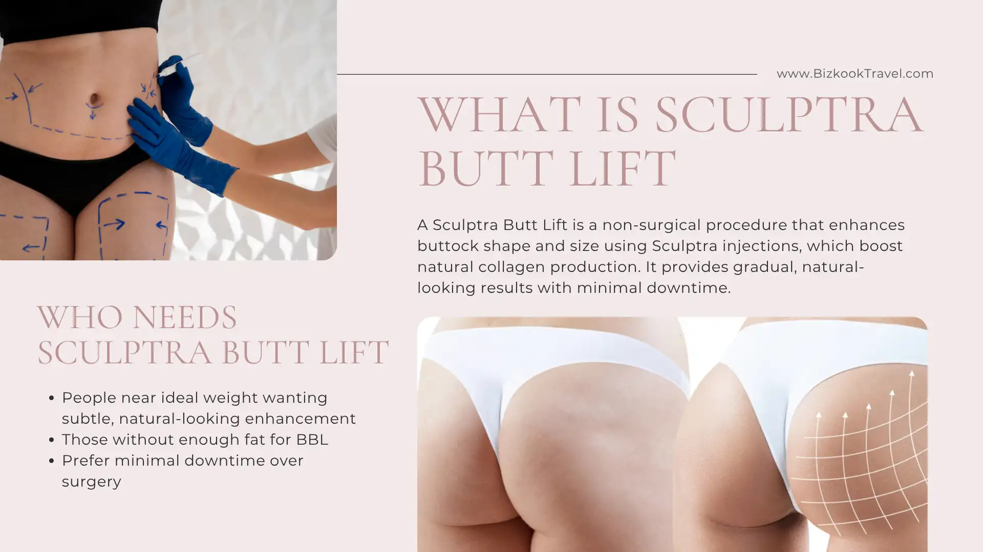 What is Sculptra Butt Lift