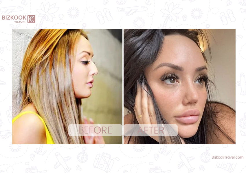 charlotte crosby plastic surgery-before-after