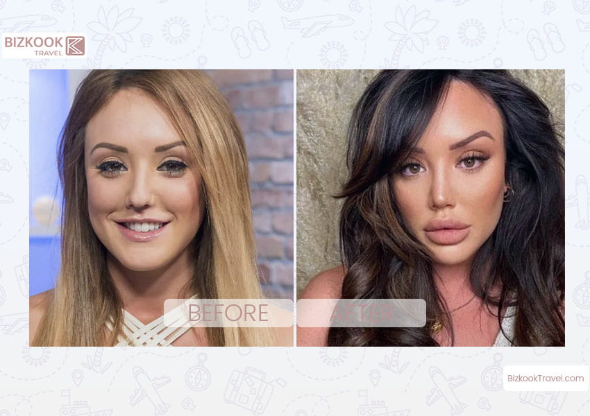 charlotte crosby plastic surgery-Lip Filler