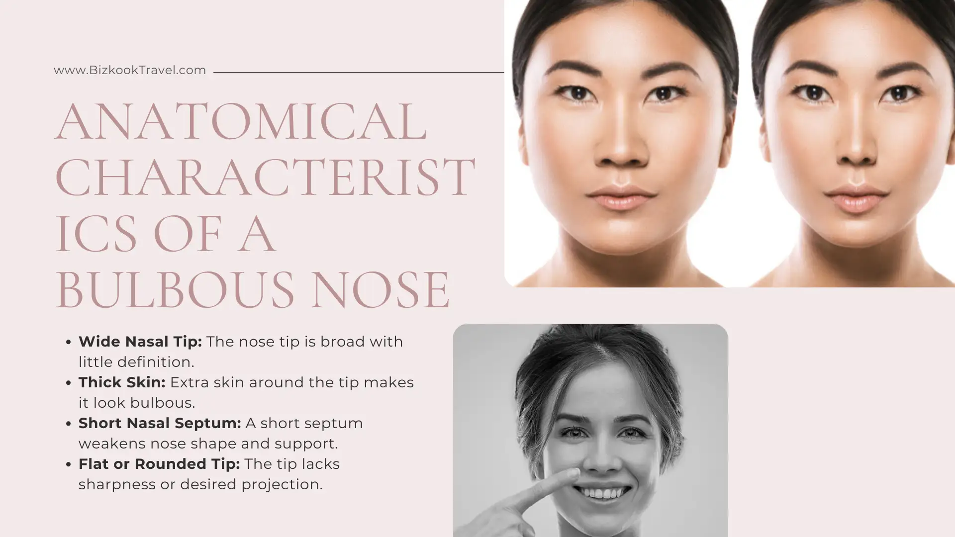Anatomical Characteristics of a Bulbous Nose